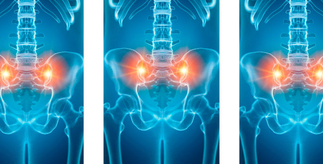 Three x-ray style images of the lower spine and pelvis, with the sacroiliac joints glowing orange.